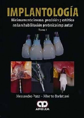Implantologia Minimamente Invasa, Precisiony Estetica En La Rehabilitacion Protesica